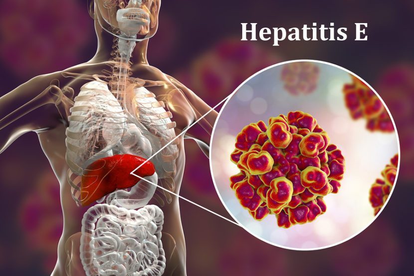 bigstock-Hepatitis-E-Viral-Infection-247374850-e1568915255101.jpg